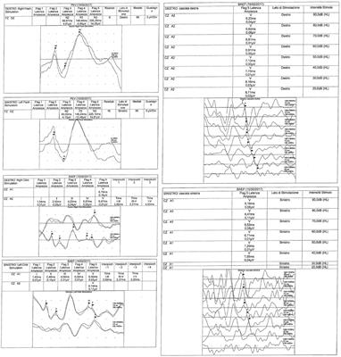 Brainstem Auditory Evoked Potentials and Visual Potentials in Kawasaki Disease: An Observational Monocentric Study